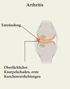 Gelenk mit Arthritis