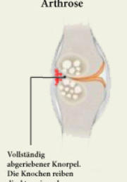 Gelenk mit Arthrose