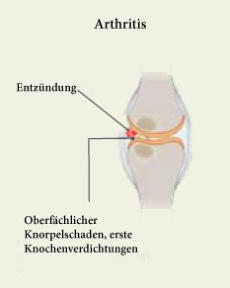 Gelenk mit Arthritis