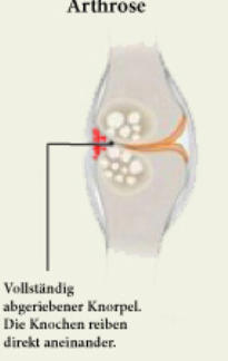 Gelenk mit Arthrose