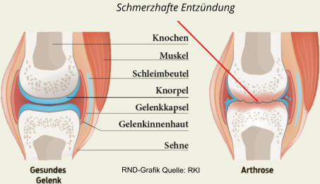 Gesundes Gelenk und Gelenk mit Arthrose