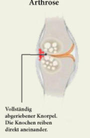 Gelenk mit Arthrose